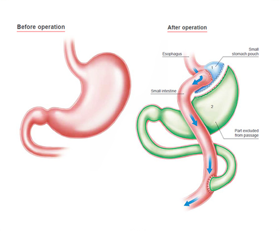 Gastric Bypass Package